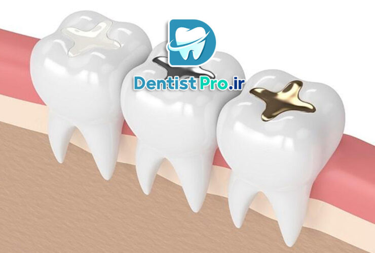 پر کردن دندان با ظاهری طبیعی و همرنگ 39 پر کردن دندان با ظاهری طبیعی و همرنگ