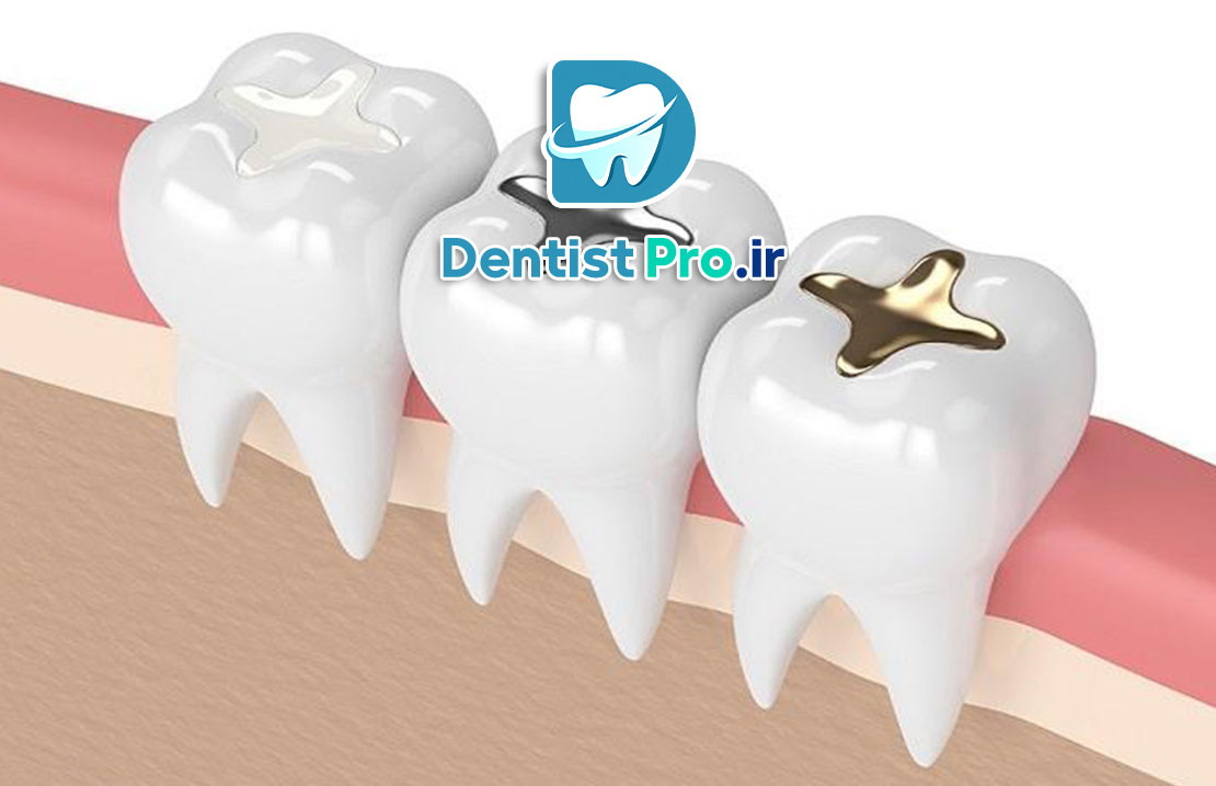 پر کردن دندان با ظاهری طبیعی و همرنگ