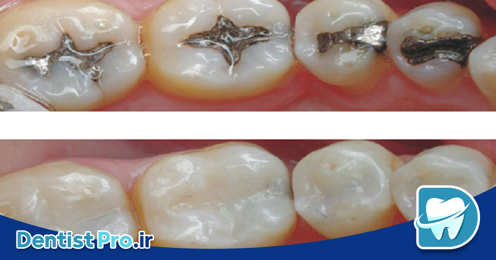 پر کردن دندان با ظاهری طبیعی و همرنگ
