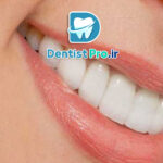 کامپوزیت ونیر طبیعی برای دندان های کوچک