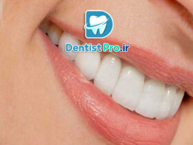 کامپوزیت ونیر طبیعی برای دندان های کوچک