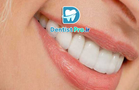 کامپوزیت ونیر طبیعی برای دندان های کوچک