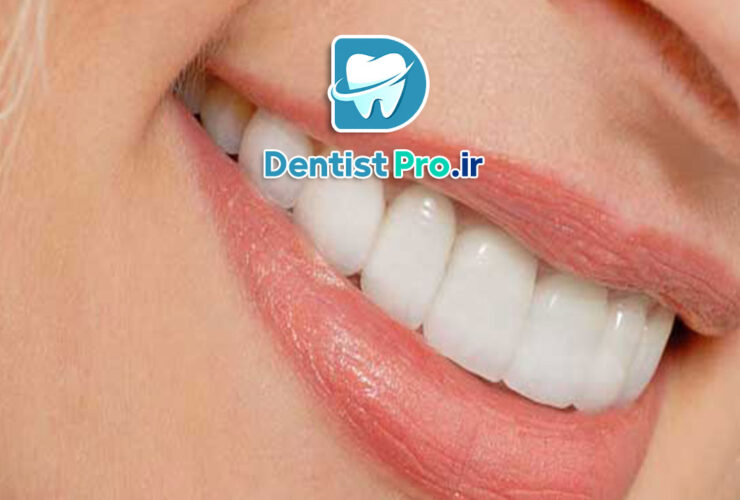 کامپوزیت ونیر طبیعی برای دندان های کوچک 31 کامپوزیت ونیر طبیعی برای دندان های کوچک