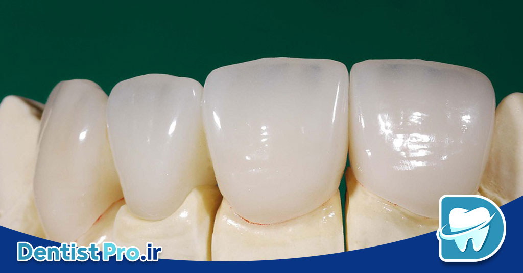 کامپوزیت ونیر طبیعی برای دندان های کوچک