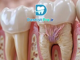 عصب کشی با بی حسی قوی برای اضطراب