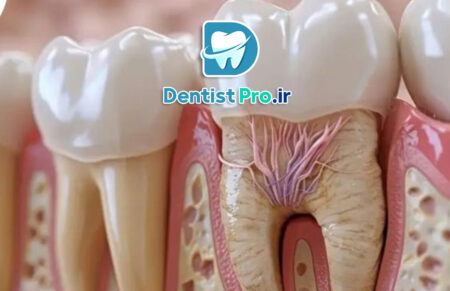 عصب کشی با بی حسی قوی برای اضطراب