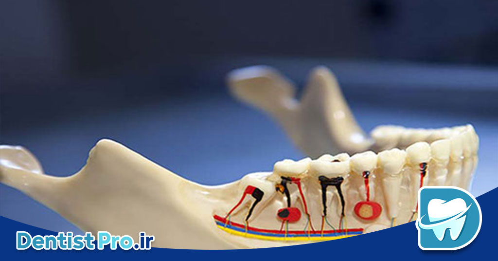 عصب کشی یک جلسه ای برای دندان عفونی: راهنمای جامع و کاربردی