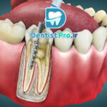 عصب کشی یک جلسه‌ای با دستگاه روتاری