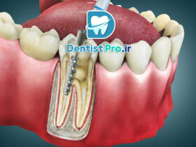 عصب کشی یک جلسه‌ای با دستگاه روتاری