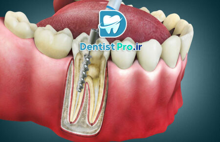 عصب کشی یک جلسه‌ای با دستگاه روتاری