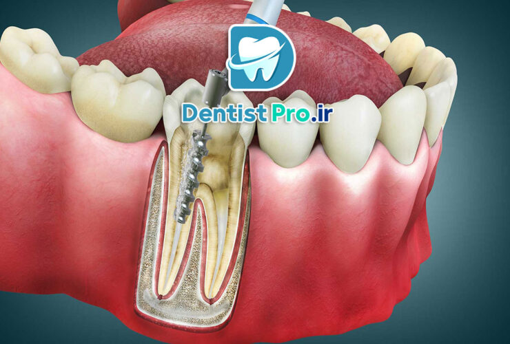 عصب کشی یک جلسهای با دستگاه روتاری 27 عصب کشی یک جلسهای با دستگاه روتاری