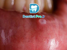 جراحی کیست دهانی با رویکرد حداقل تهاجم