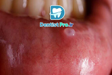 جراحی کیست دهانی با رویکرد حداقل تهاجم