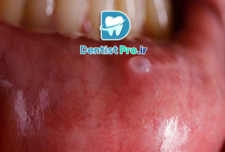 جراحی کیست دهانی با رویکرد حداقل تهاجم 27 جراحی کیست دهانی با رویکرد حداقل تهاجم