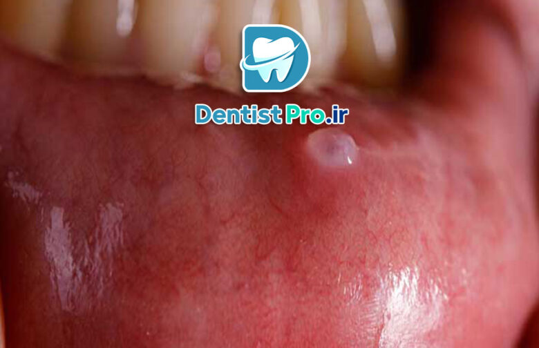 جراحی کیست دهانی با رویکرد حداقل تهاجم