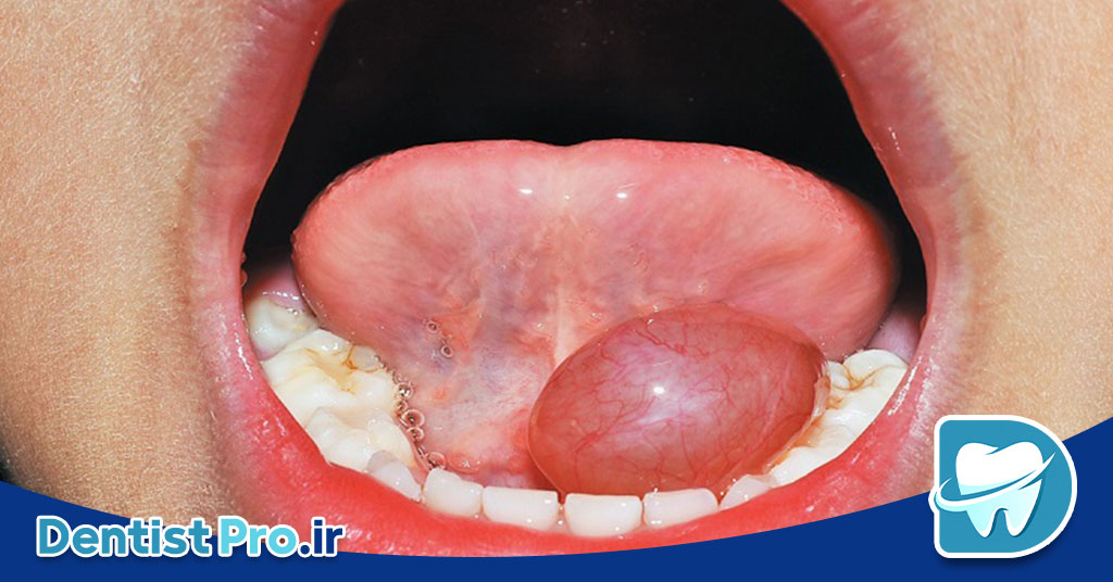 جراحی کیست دهانی با رویکرد حداقل تهاجم 26 جراحی کیست دهانی با رویکرد حداقل تهاجم