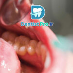 جراحی تومورهای دهانی