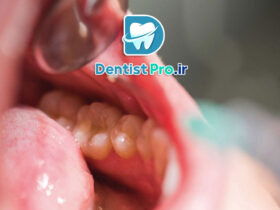 جراحی تومورهای دهانی