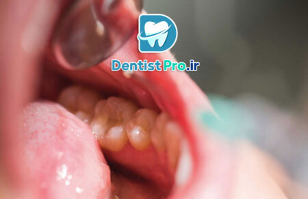 جراحی تومورهای دهانی