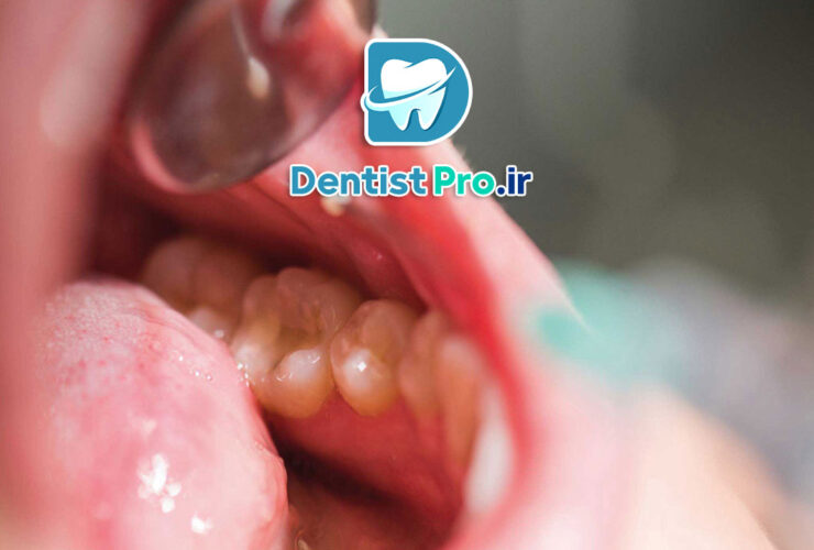 جراحی تومورهای دهانی