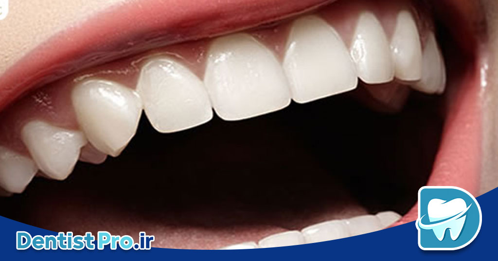 ارتودنسی برای مرتب کردن دندان های جلو: راهنمای کامل