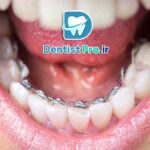 ارتودنسی برای مرتب کردن دندان های جلو: راهنمای کامل