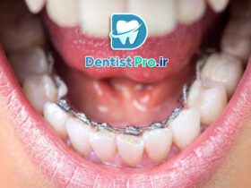 ارتودنسی برای مرتب کردن دندان های جلو: راهنمای کامل