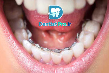 ارتودنسی برای مرتب کردن دندان های جلو: راهنمای کامل