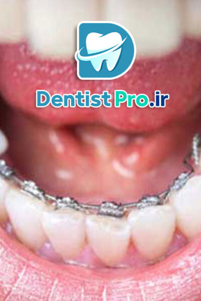 ارتودنسی برای مرتب کردن دندان های جلو: راهنمای کامل