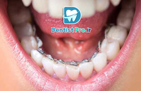 ارتودنسی برای مرتب کردن دندان های جلو: راهنمای کامل