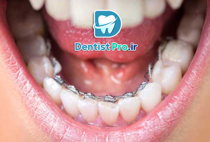 ارتودنسی برای مرتب کردن دندان های جلو: راهنمای کامل 39 ارتودنسی برای مرتب کردن دندان های جلو: راهنمای کامل