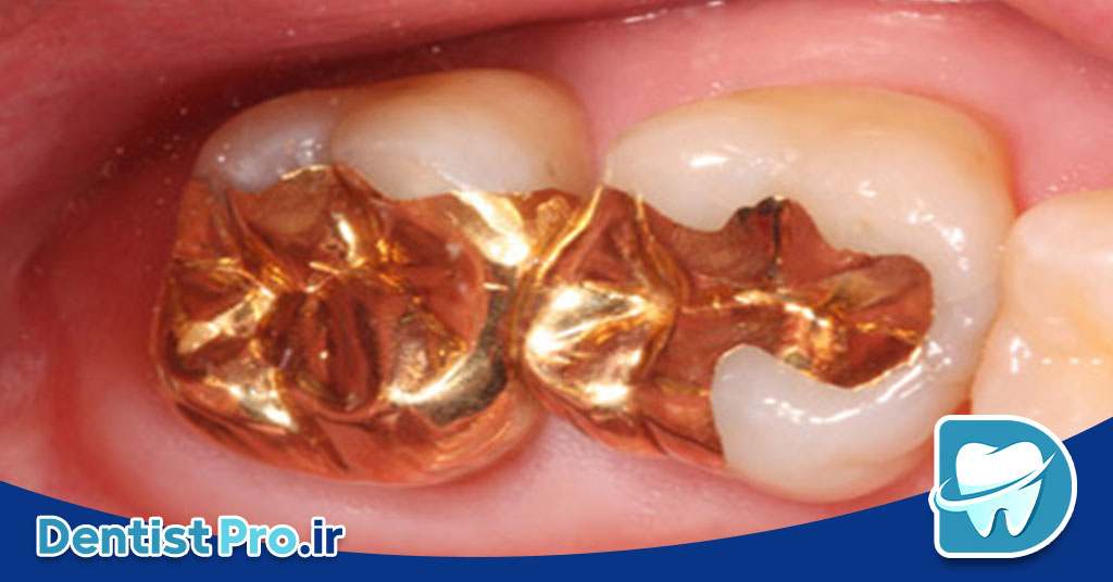 ترمیم پوسیدگی عمیق بدون درد 26 ترمیم پوسیدگی عمیق بدون درد