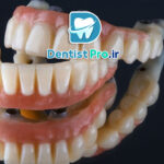 قیمت پروتز دندان کامل با ظاهر طبیعی صورت