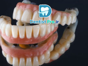 قیمت پروتز دندان کامل با ظاهر طبیعی صورت