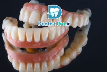 قیمت پروتز دندان کامل با ظاهر طبیعی صورت