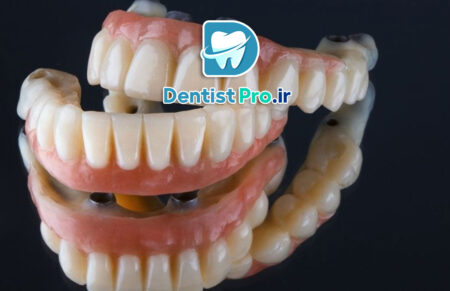 قیمت پروتز دندان کامل با ظاهر طبیعی صورت
