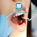 روکش محافظ دندان بعد از عصب کشی