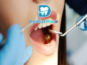 روکش محافظ دندان بعد از عصب کشی