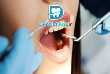 روکش محافظ دندان بعد از عصب کشی