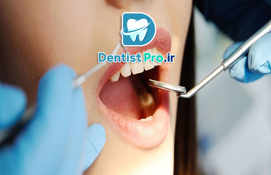 روکش محافظ دندان بعد از عصب کشی 25 روکش محافظ دندان بعد از عصب کشی