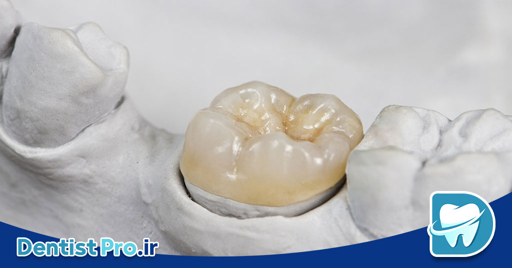 روکش محافظ دندان بعد از عصب کشی 26 روکش محافظ دندان بعد از عصب کشی