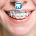 ارتودنسی سریع برای بزرگسالان چگونه انجام می شود؟