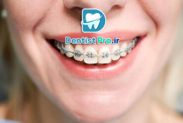 ارتودنسی سریع برای بزرگسالان چگونه انجام می شود؟