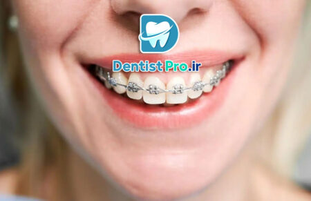 ارتودنسی سریع برای بزرگسالان چگونه انجام می شود؟