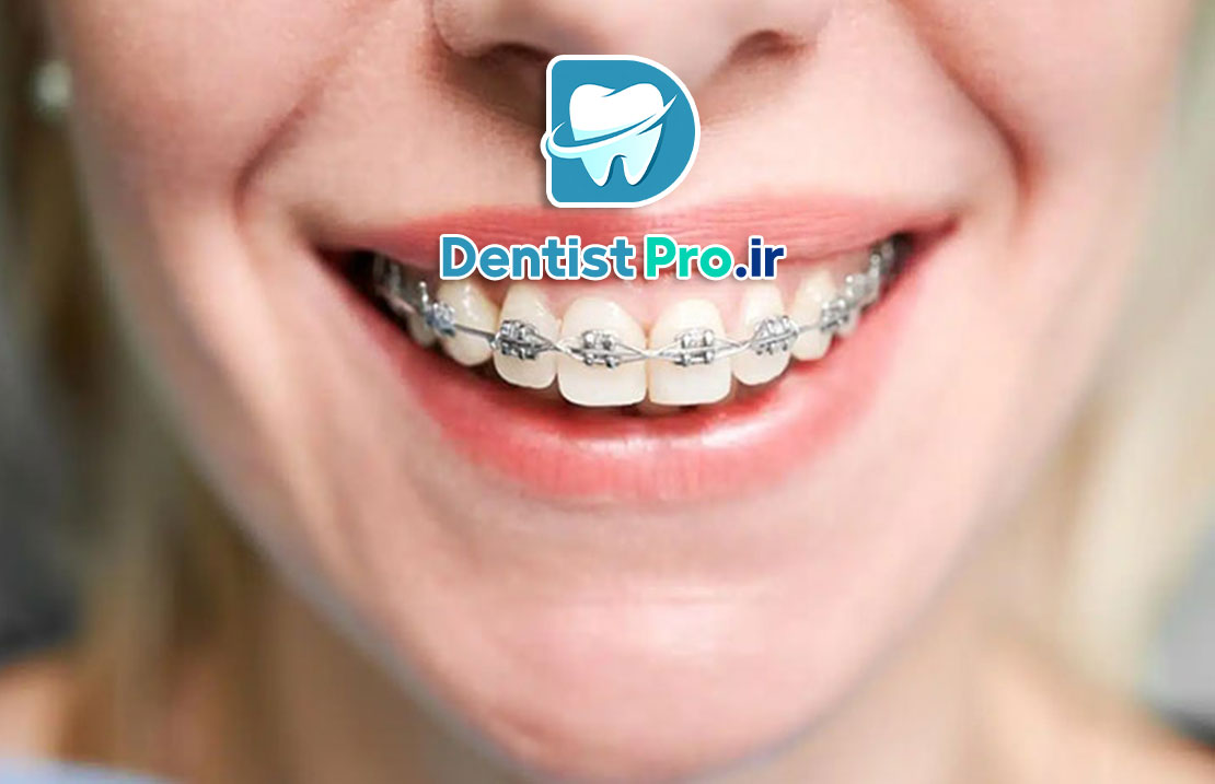 ارتودنسی سریع برای بزرگسالان چگونه انجام می شود؟