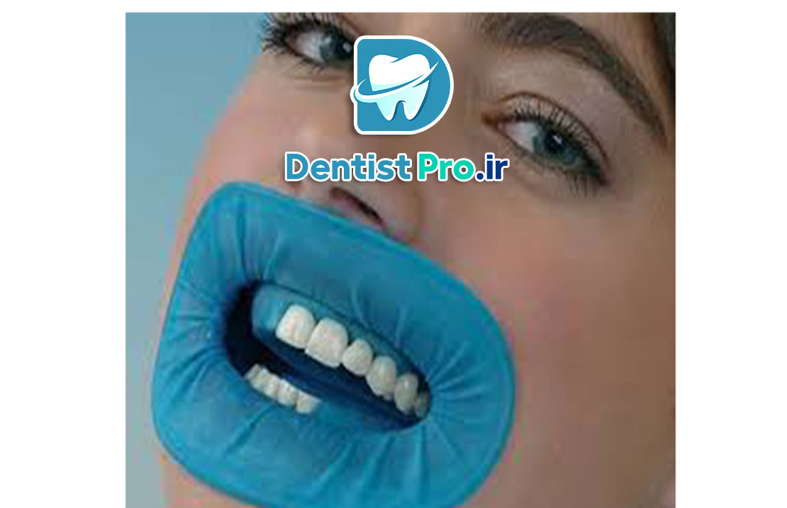 عصب کشی مجدد دندان ترمیم شده 25 عصب کشی مجدد دندان ترمیم شده