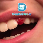 ترمیم شکستگی کوچک مینای دندان