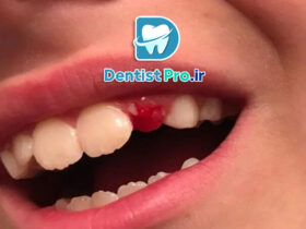 ترمیم شکستگی کوچک مینای دندان