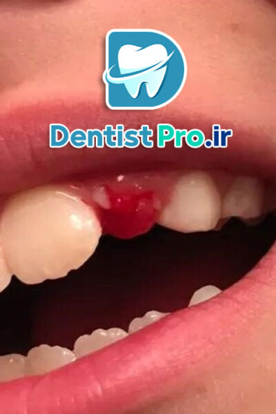 ترمیم شکستگی کوچک مینای دندان