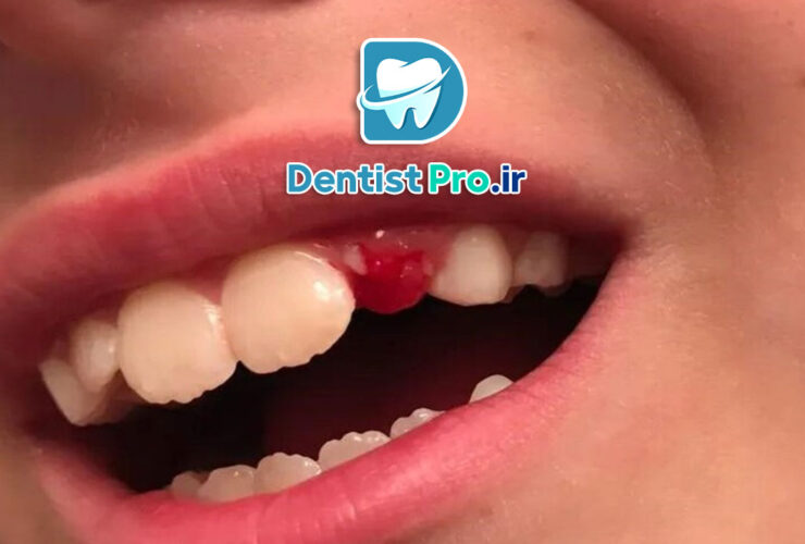 ترمیم شکستگی کوچک مینای دندان 27 ترمیم شکستگی کوچک مینای دندان